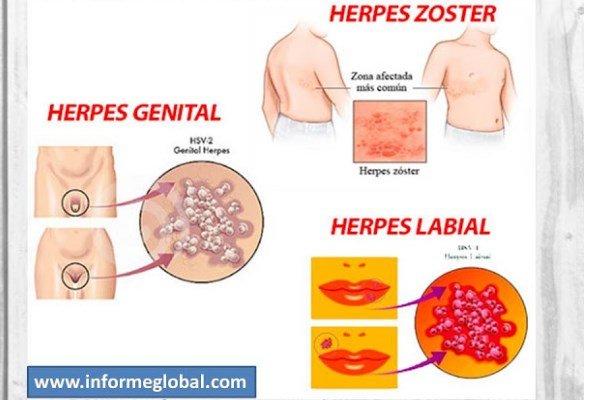 tipos de herpes genital zooster labial