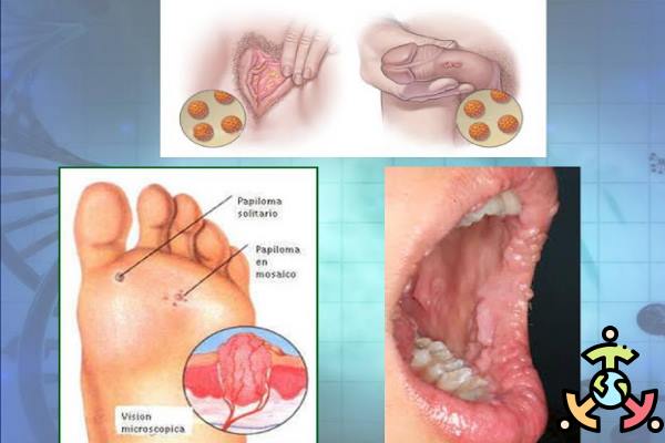virus del papiloma y sus sintomas